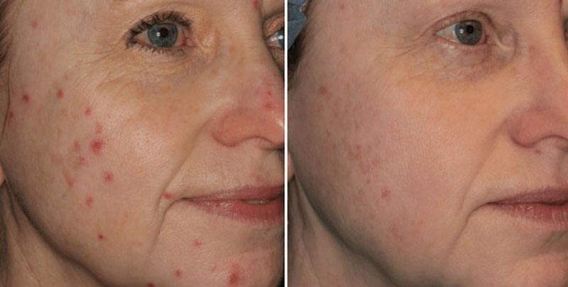 Forever Clear BBL before and after — Radiance Medical Aesthetics