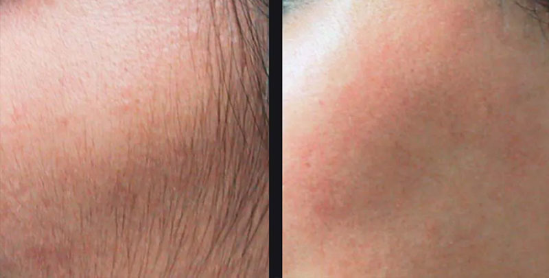 Laser Hair Reduction before and after — Radiance Medical Aesthetics