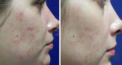 Microneedling acne scar before and after — Radiance Medical Aesthetics