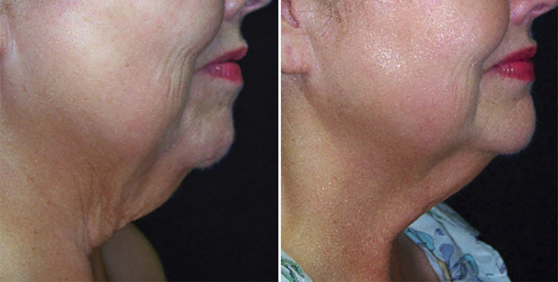 Laser Hair Reduction before and after — Radiance Medical Aesthetics