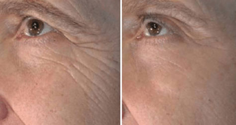 RF Microneedling skin rejuvenation before and after — Radiance Medical Aesthetics